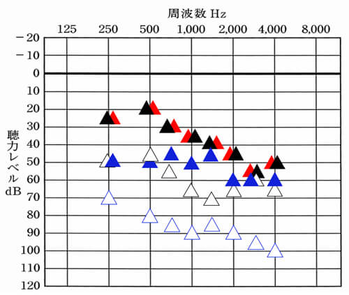 それぞれ、▲が補聴器を両耳ともつけた状態。△が補聴器なし。▲が右側のみつけた状態。▲が左側のみつけた状態。△は、左側のみで補聴器なしの状態を調べたもの。左右で聴力が異なる場合は、両耳ぶん、調べないと状況がわかりにくいため、このように調べて、状況をまず把握することが改善の一歩となります。
