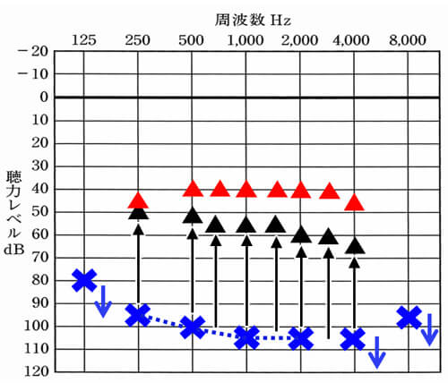 仮に低下した左側を補聴器で補おうとすると、頑張って▲くらいの改善値。しかし、一般的な音声の大きさを理解するのに必要な数値は、▲(平均40dBほど)は、必要になる。さらに、少し声の小さい方や少し距離が離れてもわかるようになるには、平均35dBくらい必要になる。その改善値まで改善させることが困難なため、聞きにくさが残りやすい。