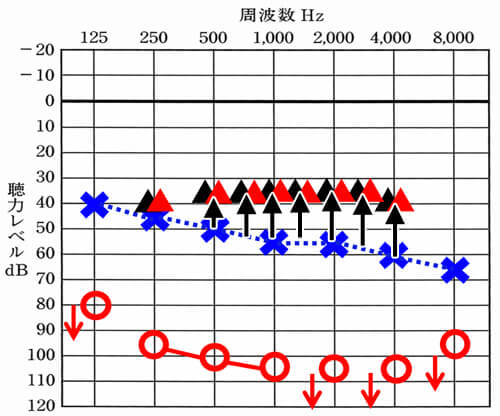 ▲が補聴器で聞こえを改善させられる目標値だとすると、そこまで▲(補聴器装用時に聞こえている数値)を持ってきて、聞きにくさを改善させる。そして、これは、どの補聴器でもできるようになっている。補聴器がしていることは、聴力が低下した部分を補聴器で補える範囲まで、補うこと。具体的には、<span style="color: #ff0000;">▲</span>が補聴器で聞こえを改善させられる目標値だとすると、そこまで▲(補聴器装用時に聞こえている数値)を持ってきて、聞きにくさを改善させる。そして、これは、どの補聴器でもできるようになっている。
