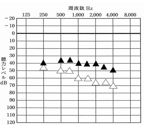 こちらは、補聴器使用時の測定の一つ、音場閾値測定(おんじょういきち測定)の結果です。▲が補聴器使用時、△が補聴器なしを表します。