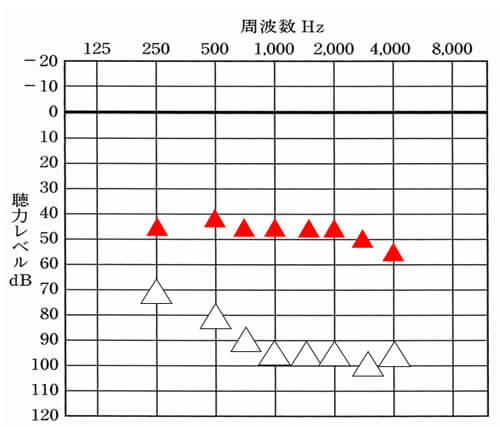 聴力がある程度、重い方の場合は、補聴器なしの測定値の半分ほどを改善目標として考えていきます。ただし、基本的に補聴器は、聞こえが低下すると低下するほど、改善値も低くなりがちです。必ず、日常生活上で使えるほどの音量なのかを確認しながら、目標値まで目指していく事が大切です。そして、無理にあげすぎないように注意しましょう。