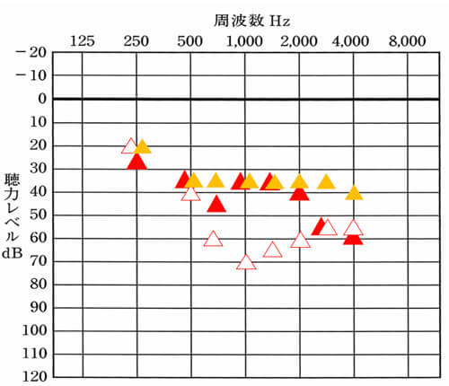 ▲は、補聴器を装用した時に改善できていると良いおおよその数値。右側は、だいたい35dBから30dBくらいになります。
