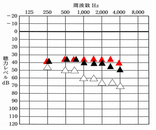▲が補聴器で目指す聞こえの改善値。▲が補聴器を装用している時の現状の聞こえ。1000Hz〜4000Hzは、目標値よりも少し低下している。このような際、その部分だけをあげたりすることがチャンネルが多い場合、しやすくなる。