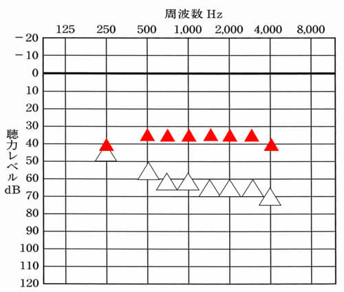 70dB手前までの聴力でしたら、だいたい35dBほど改善できると良いです。両端(250Hz、4000Hz)は、-5dBくらいになると良いですね。なお、中には、35dBではなく平均30dBほどまで改善するケースもありますが、周囲の音が大きくなったり、良くも悪くも聞こえがよくなりますので、あくまでも使える方のみになります。
