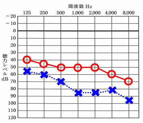 このように片耳が大きく下がっているケースは、無理に左右のバランスを整えようとすると、聞こえない耳側（このケースの場合は、左耳）に多大な負荷をかけることがありますので、感覚を確認しながら、改善していくことが大切です。