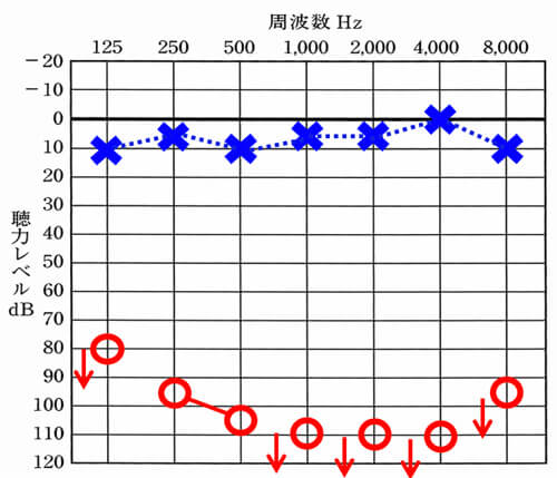 こちらは、片耳は聞こえるけれどももう片耳は、聞こえない。という方が対象です。聞こえないレベルは、軽度のものから、重度のものまで対象です。