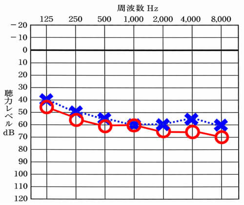 典型的な中等度難聴の図。