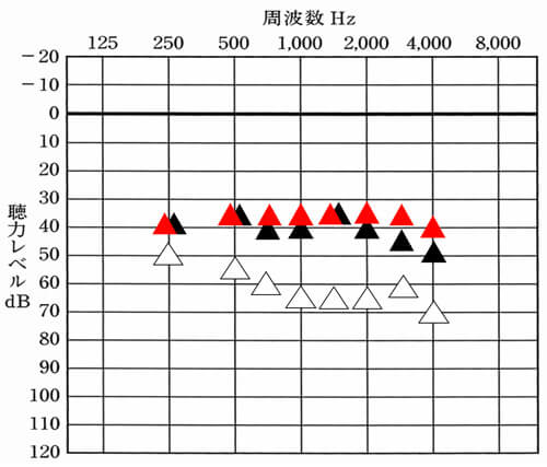補聴器には、聴力から補えると良い数値があります。測定を行いながら、状況を把握できると、今現在、どのようになっているのか。そして、どの部分が改善できており、どの部分が改善できていないのか。仮に改善するとしたら、どこを改善すると良いのか、がわかるようになります。なお、数値に関しては、▲が補聴器あり、▲が改善目標値、△が補聴器なしを表します。