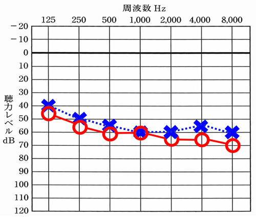 こちらは、両耳とも同じくらいの聴力の方が対象です。