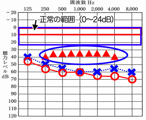 今現在の補聴器では、残念ながら正常の範囲まで聞こえを改善させることはできません。しかし、然るべきことをすればそれなりに改善させることはできます。