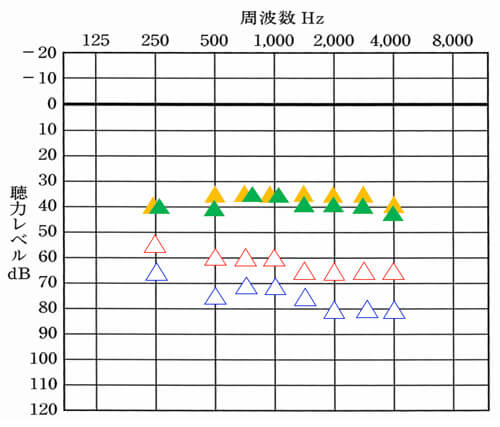 これは、補聴器使用時の測定も同様です。印が多くて申し訳ないのですが、<span style="color: #ff0000;">△</span>が右側の補聴器なし。<span style="color: #ffcc00;">▲</span>が右側の改善目標値。<span style="color: #0000ff;">△</span>が左側の補聴器なし。<span style="color: #339966;">▲</span>が左側の改善目標値。となります。色が多いので、改善目標値は、それ以外の色で記載しています。