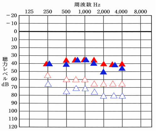 ▲が右側のみの補聴器使用時。▲が左側のみの補聴器使用時。状況を把握できれば、自ずと、状況を改善させることもできるようになります。なお、こちらの数値と先ほどの改善目標値を合わせることにより、現状はどうなのかもわかるようになります。