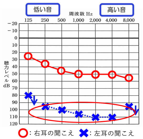 下がっている部分が大きいと大きいほど、補聴器では、効果が出にくくなるため、そのようなケースは、バイクロス補聴器の方が、改善しやすくなります。