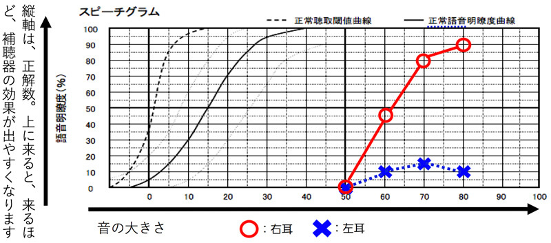 逆に、かなり低い場合は、バイクロス補聴器の方が、改善できる確率は、高くなります。