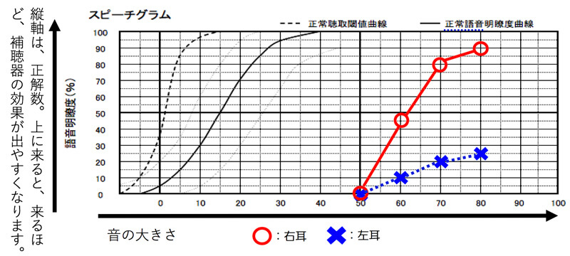 耳の場合、言葉を理解する力といいますか、言葉を聞こえる音量から流し、どれくらい理解できるのか。を調べる測定があります。一部の耳では、著しくこの部分が低下しており、補聴器の効果を非常に得にくくなるケースがあります。なお、数値に関しては、一番良いところを最良値として考えていきます。