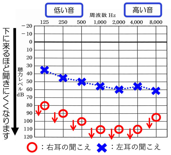 軽度・中等度といっても色々な耳があります。このように片耳のみ軽度・中等度難聴でも、改善できる補聴器をご用意しています。