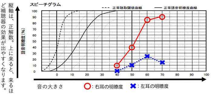 片側だけ、非常に言葉の理解度が低い耳もたまに見かけます。そのような方の場合、補聴器を両耳装用しても、聞こえにくい側は、補聴器が合わず、全然、効果を得られないことがあります。