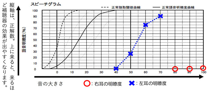 聴力低下が大きすぎる場合(100B以下など)は、調べないケースもあります。