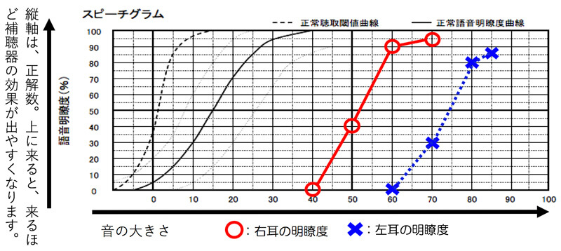 言葉の聞こえの明瞭度を調べた際に、音を入れると理解しやすいケースも同様です。そのような方の場合は、両耳装用にした方が、最終的な聞きにくさは、改善しやすくなります。