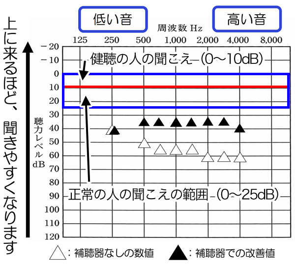 バイクロス補聴器で改善させた場合も、このくらいまで改善されます。さらに聞こえない耳側の聞こえも、聞こえる耳側と同じくらいまで改善される傾向があります。