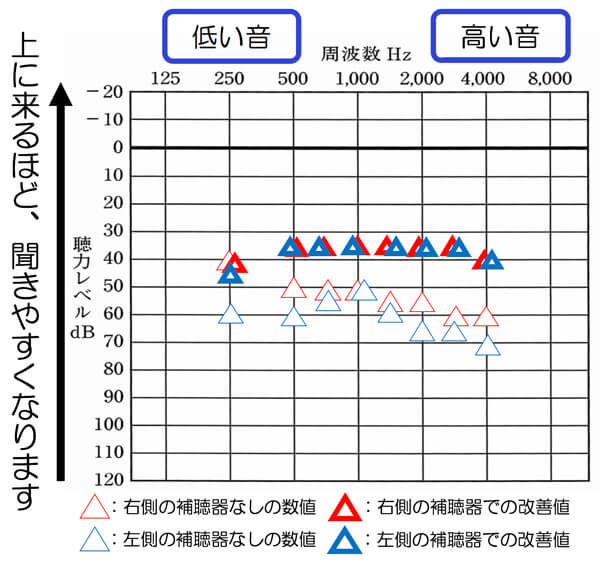 聴力差は、少なければ少ないほど、バランスは、とりやすくなります。そこまで大きくないのであれば、なるべくバランスは、整えられると、ベストになります。