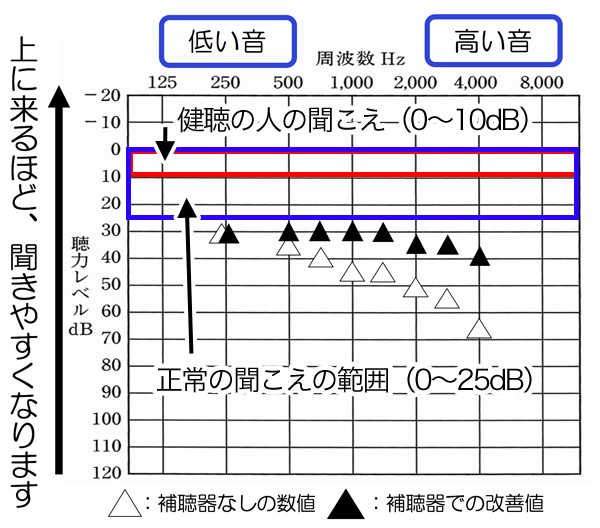 高い音が聞こえにくい場合、概ね、この辺りまで改善しますが、高い音(2000Hzより先)は、聴力によって、大きく変化します。