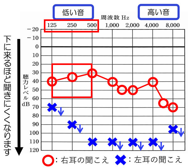 耳あな形補聴器は、125〜500Hzのあたりが、60dBくらいまでの聞こえの方の場合、こもり、閉塞感、自分の声が大きく聞こえる感覚。それらを感じやすくなります。