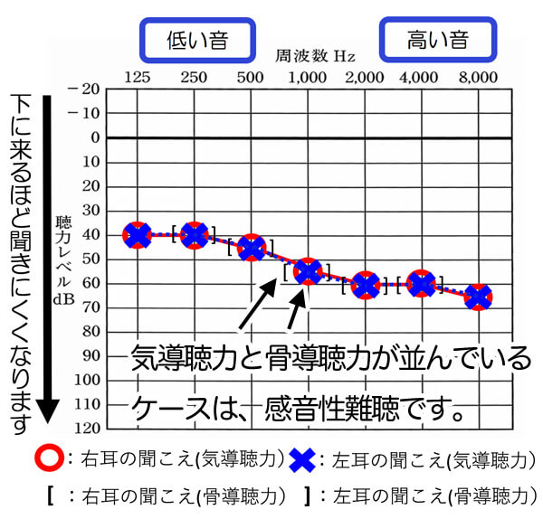 感音性難聴の7つの基本概要と8つの聴力別 補聴器での改善方法 パートナーズ補聴器