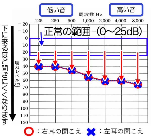 聴力の正常の範囲は、0〜25dBまでになります。それよりも、聴力が落ちると、落ちるだけ、聞きにくさが出てきます。