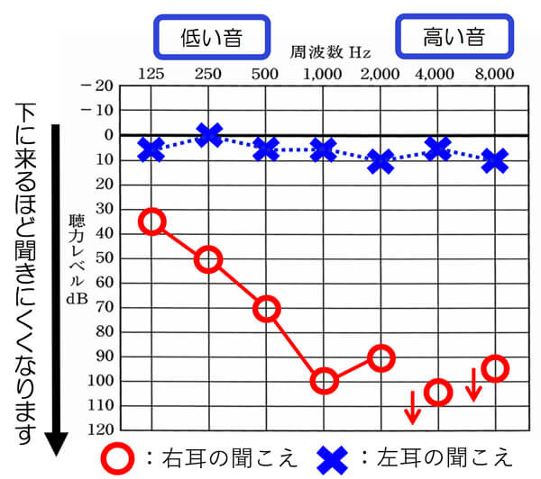 中には、聴力的に補うのが、厳しい聞こえのケースもあります。