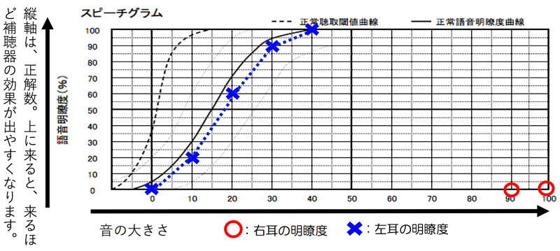 仮に片耳のみ全く聞こえない方を調べると、概ね、このような状態になります。聞こえている耳側は、正常で、聞こえていない耳側は、全く数値が出てこない状態です。なお、実際には、聞こえる耳側は、測定することはなく、聞こえていない耳側も、100dBを超えてくると、調べる事は、ほとんどしなくなります。