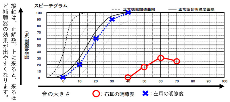 中等度くらいの難聴でも、難聴になった要因によっては、かなり下がるケースがあります。このような状況になるのは、突発性難聴、聴神経腫瘍摘出手術により、聞きにくくなったケースなどに見られます。