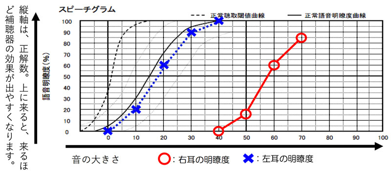 その場合、調べてみると、聞こえを補聴器で改善できるケースもあります。