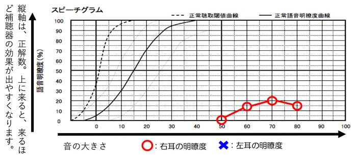 耳には、音声を流し、それがどれだけ聞き取れたかを調べる測定があります。補聴器の適性は、最良の値が50%以上の場合になり、それよりも低い場合は、補聴器を装用しても、言葉が聞きやすくなる感覚は、得にくくなります。