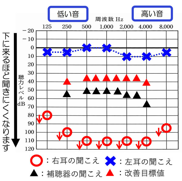 先ほどの改善度を持っても、全体的に聞きやすくするには、まだ足りない状態になります。さらに、片耳は、聞こえているため、補聴器の効果は、本当に感じにくくなります。