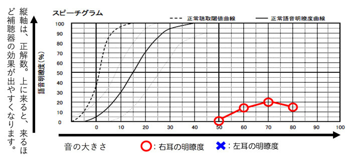 耳の状態によっては、補聴器で聞こえを改善させても、音声が聞こえるようになりづらい耳もあります。