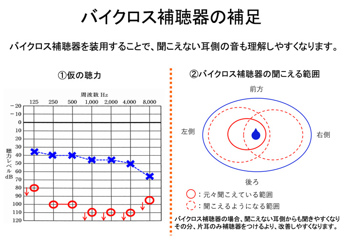 バイクロス補聴器の場合は、最も聞こえにくくなりやすい部分も含めて、改善する機器になります。