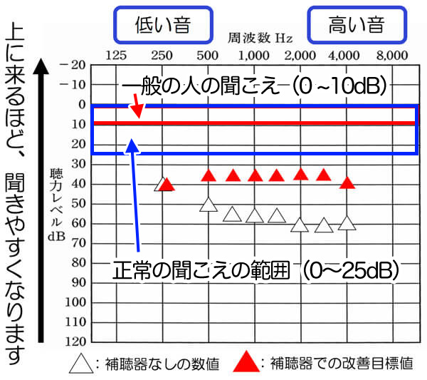 聞こえの改善例。正常の聞こえの範囲には、少し及ばないが、それに近づけることで、聞こえにくさの改善は、しやすくなります。
