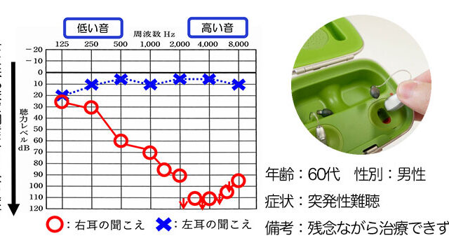 【改善事例】右耳、突発性難聴の方、クロス補聴器で改善