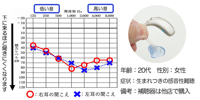 【20代女性】生まれつき高度難聴の方、補聴器で改善