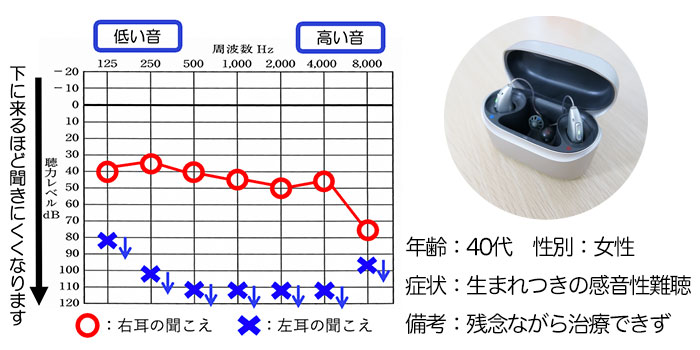 【40代、女性】生まれつきの感音性難聴の方、バイクロス補聴器にて改善