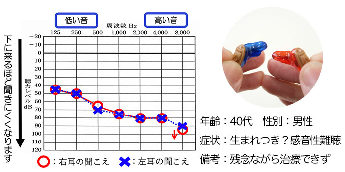 【40代・男性】生まれつきの感音性難聴の方、CIC補聴器で改善