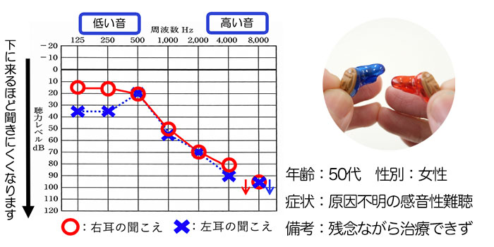 【50代・女性】原因不明の感音性難聴（高音）の方、補聴器で改善