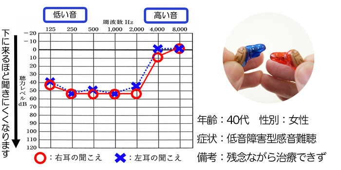 【40代・女性】低い音が聞こえにくい難聴の方、CIC補聴器で改善