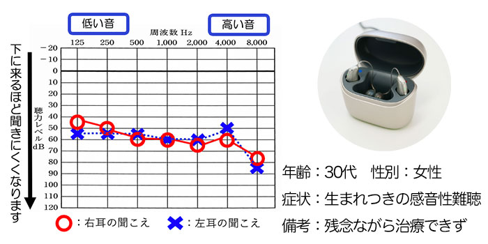 【30代、女性】生まれつきの感音性難聴の方、RIC補聴器で改善