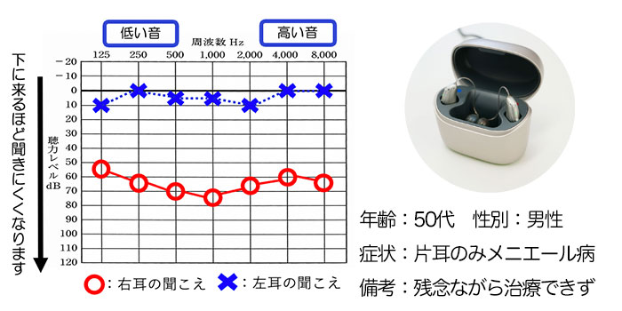 【50代・男性】片耳のみメニエール病の方、補聴器で改善