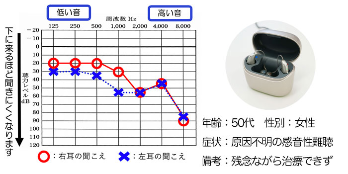 【50代・女性】他店でうまくいかなかった原因不明の感音性難聴の方、RIC補聴器で改善